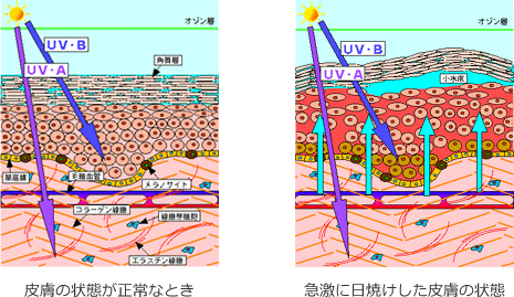 正常なときと日焼けをしたときの皮膚の状態